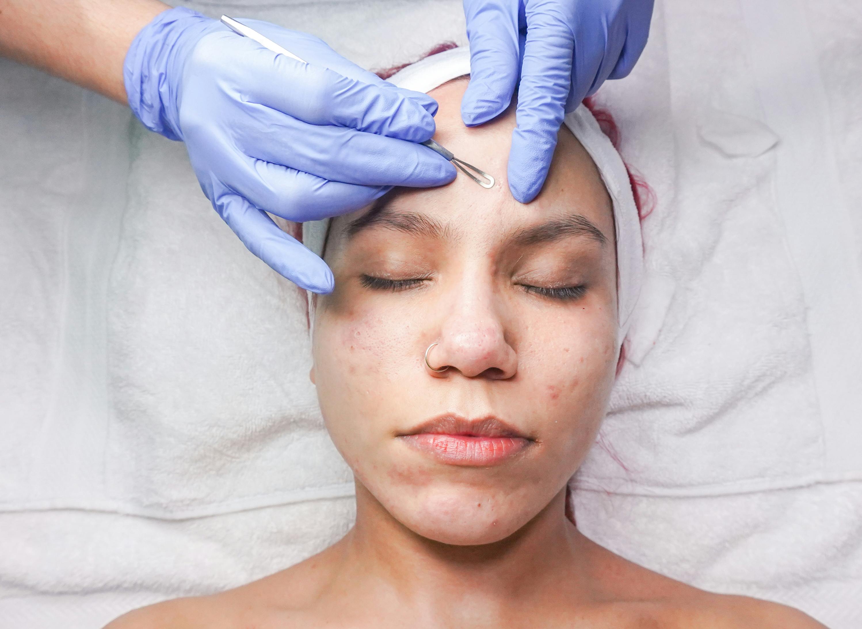 Skin Boosters للنضارة